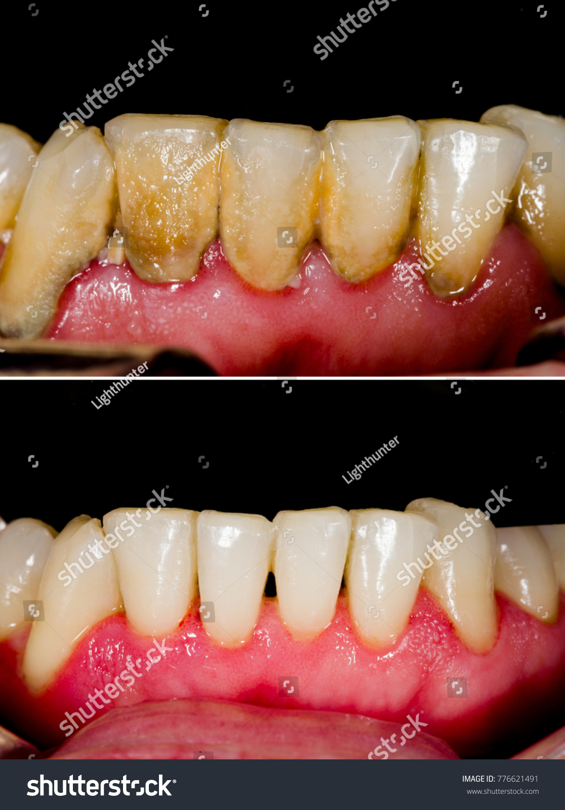 Teeth Whitening at Dr. Dhanshree's Dental Clinic